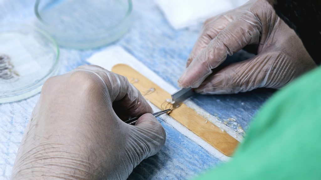 Hair transplant in Delhi